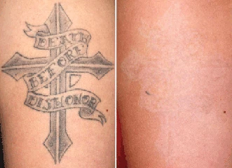 Tattoo removal New York services using laser technology