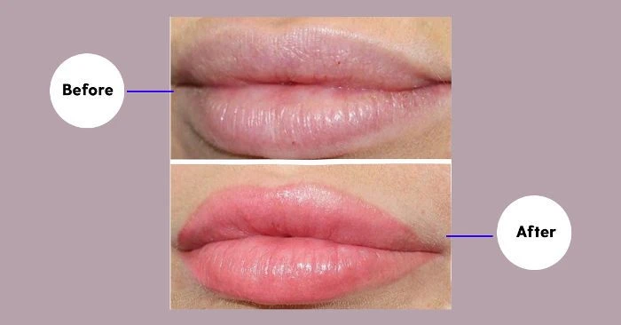 Is Tattoo Removal NYC Painful? A Case Study from First Class Cosmetics