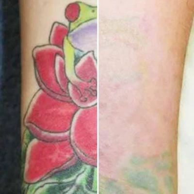 Tattoo Removal New York services
