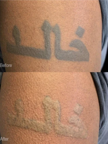 Is Tattoo Removal NYC Safe?