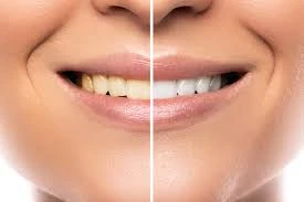 Progress Towards Your Career With Teeth Whitening Specialist Together With The Makeup Courses