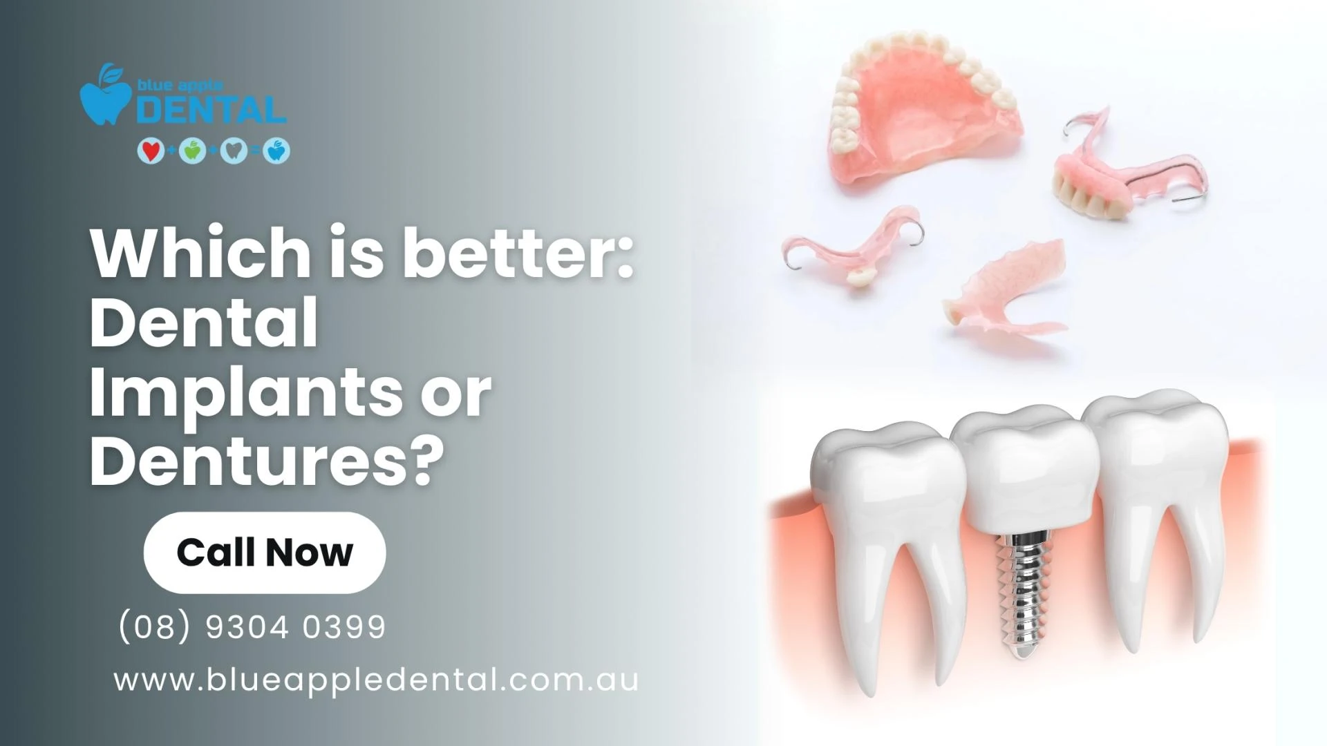 Which is better: Dental Implants or Dentures?