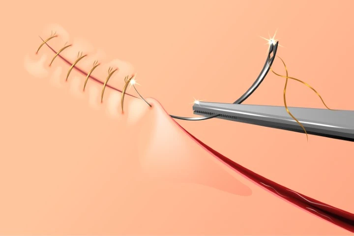 Japan Surgical Sutures Market Size, Share, Growth and Forecast 2024-2032