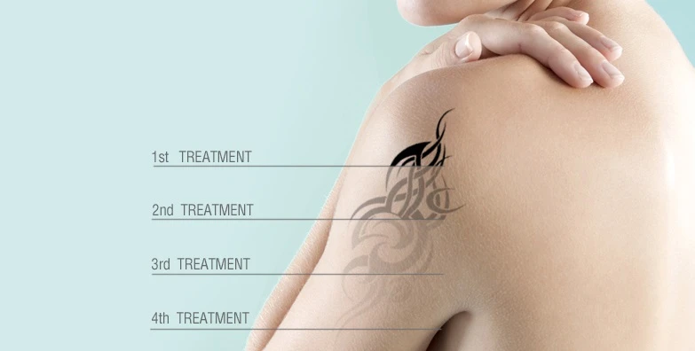Erase Your Ink Regrets: Discover the Benefits of Laser Tattoo Removal in Dubai