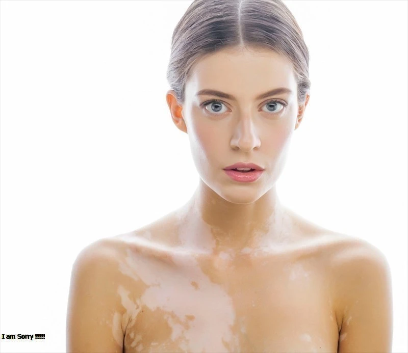 Can Laser Hair Removal trigger Vitiligo?