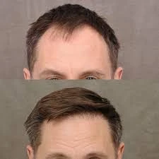 Hair Transplant Recovery Timeline