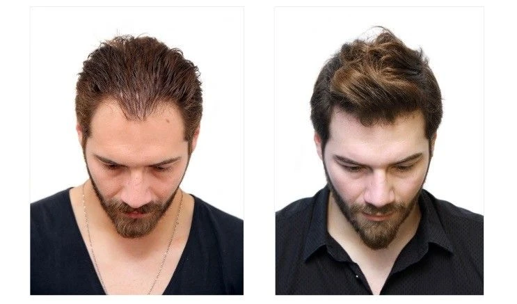 What is the average time it takes for hair transplant results to last?