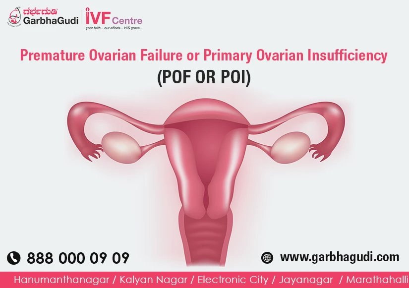 What Is POF (Premature Ovarian Failure)