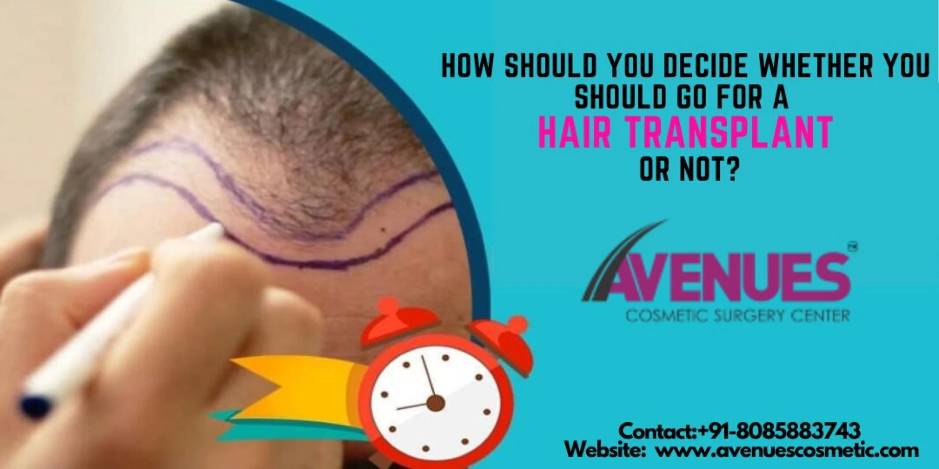 How should you decide whether you should go for a hair transplant or not?