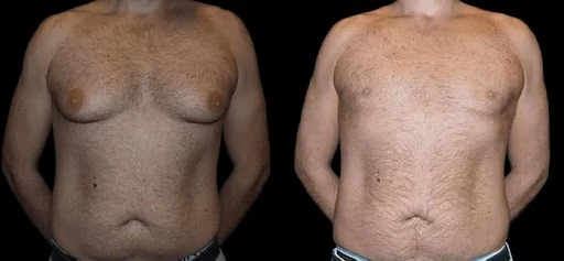 What to Expect on the Day of Your Male Breast Reduction Surgery in Dubai