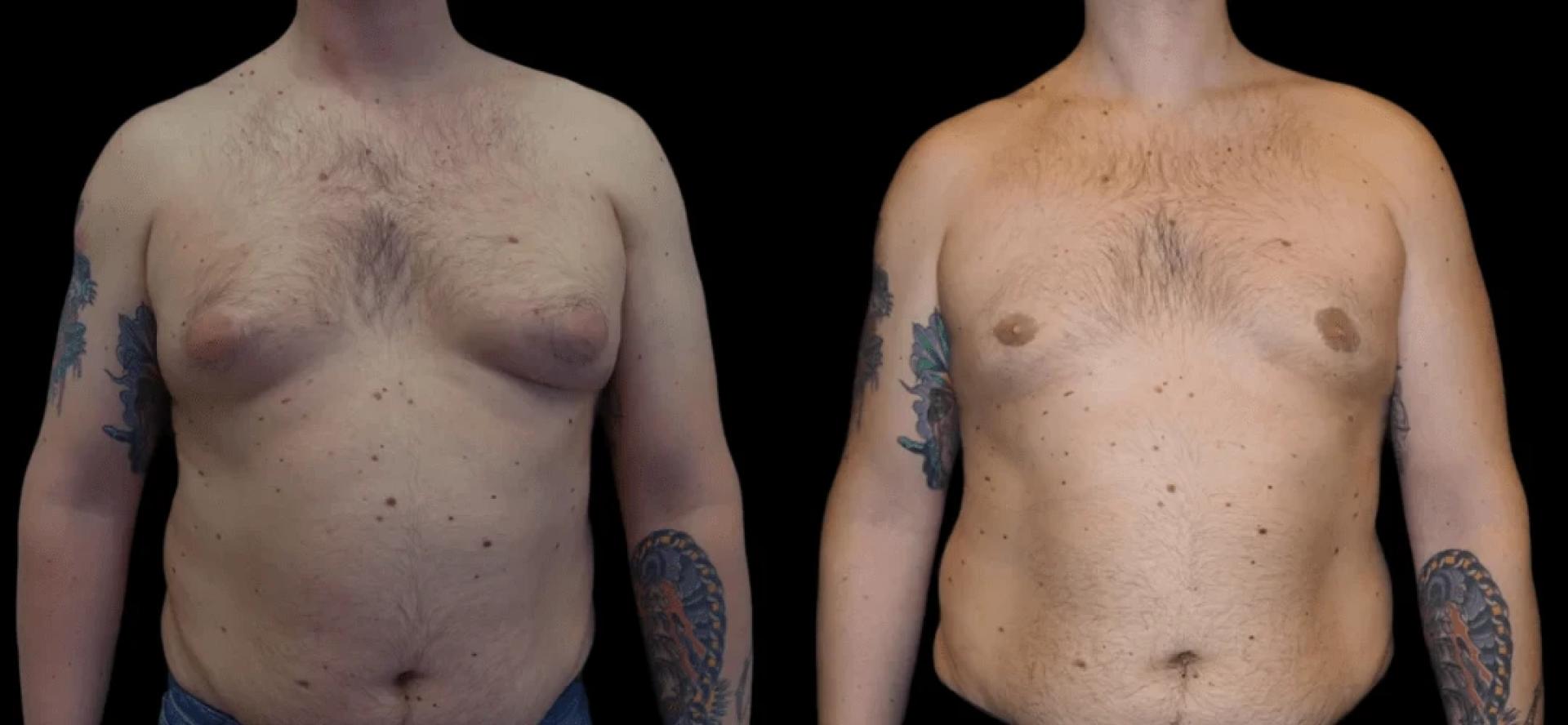 The Psychological Impact of Gynecomastia and Its Treatment