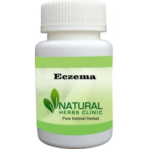 Herbal Treatment for Eczema | Natural Remedies | Natural Herbs Clinic
