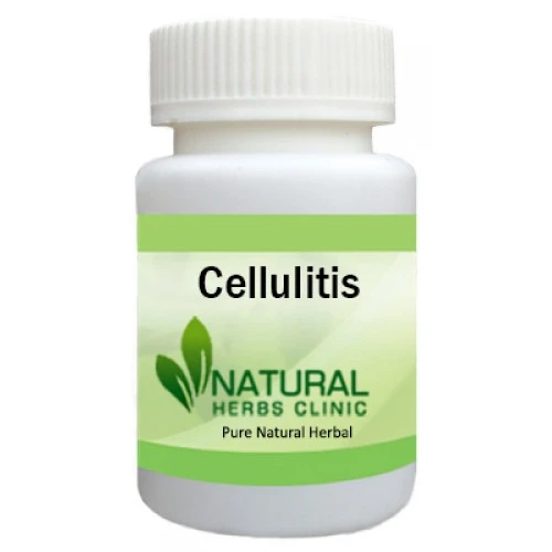 Herbal Treatment for Cellulitis | Natural Remedies | Natural Herbs Clinic