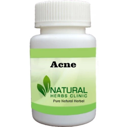 Herbal Treatment for Acne | Natural Remedies | Natural Herbs Clinic