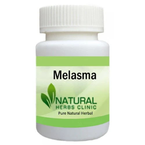 Herbal Treatment for Melasma - Natural Herbs Clinic