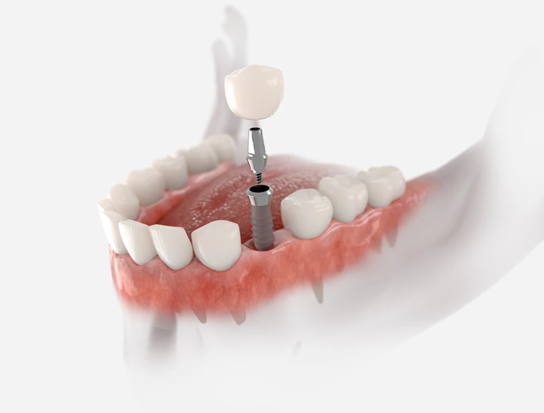 Everything You Need to Know About Dental Implants: Procedure, Cost, and More