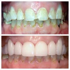 The Role of Veneers in Cosmetic Dentistry