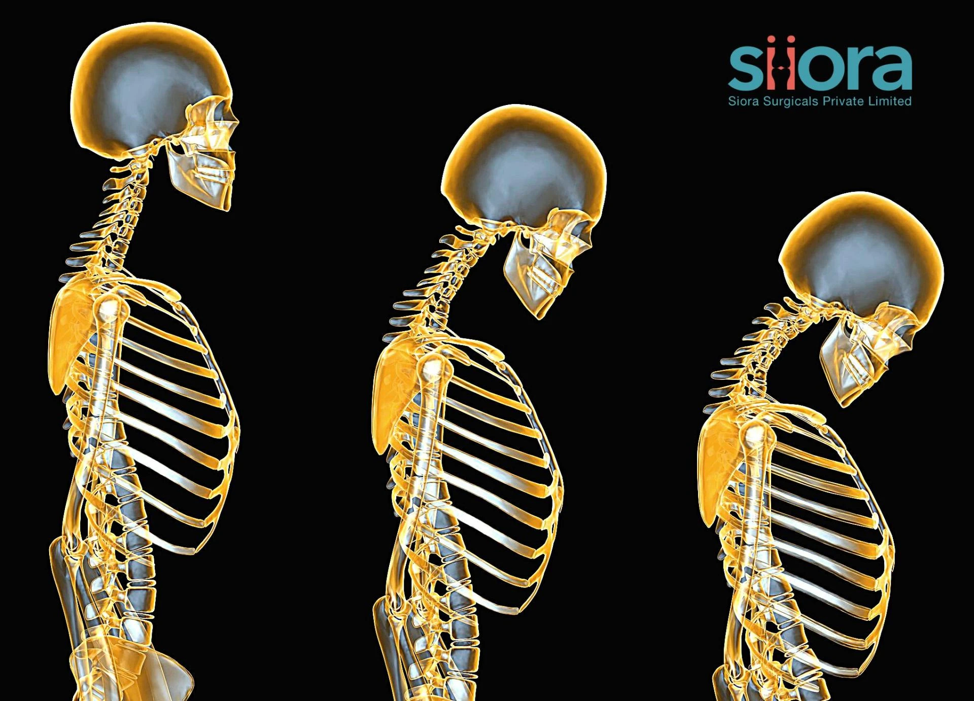 Tips to Prevent Osteoporosis