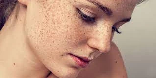Unveiling the Secrets of Flawless Skin: Defeating Freckles and Blemishes