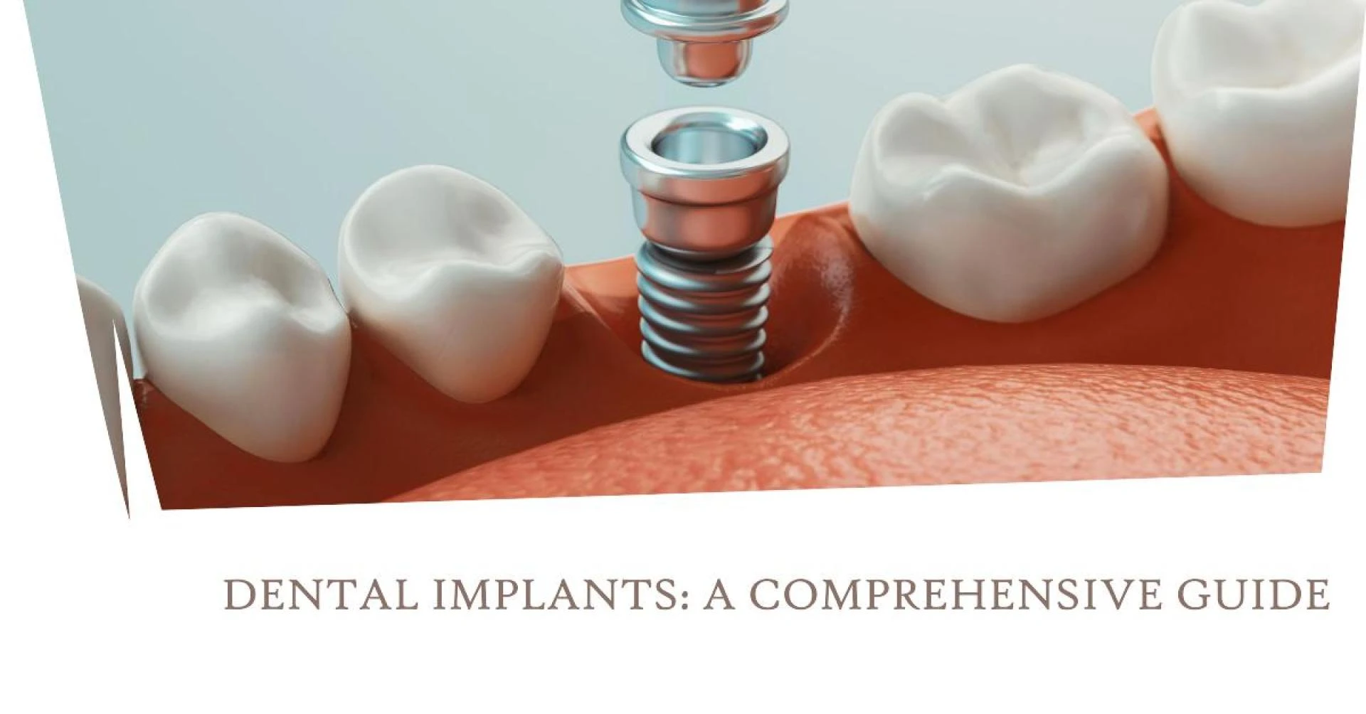 Exploring the Various Types of Dental Implants: A Comprehensive Guide