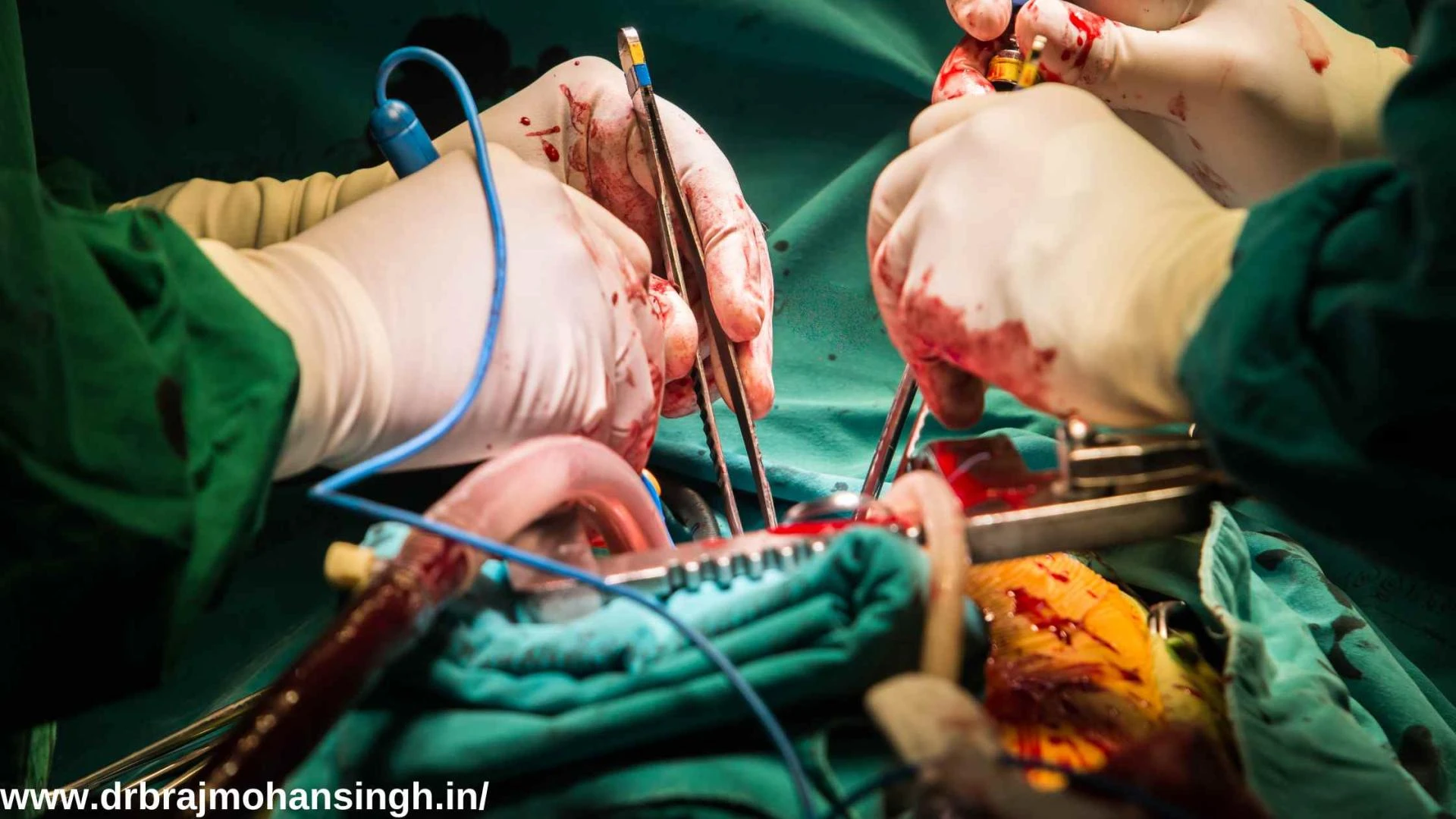 Expert Guide To Understanding Heart Care : Best Bypass Heart Surgeon In Bhavnagar