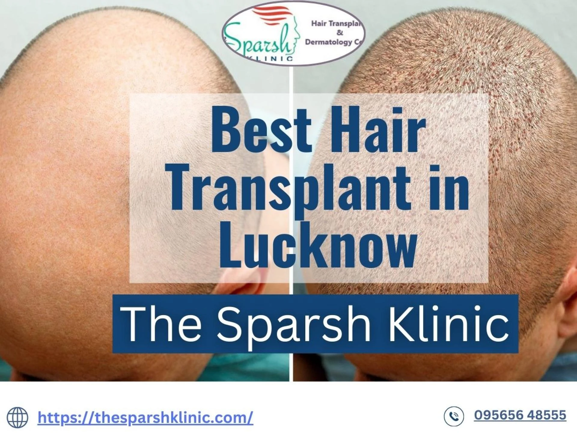A Comprehensive Guide on Choosing the Best Hair Transplant Clinic in Lucknow