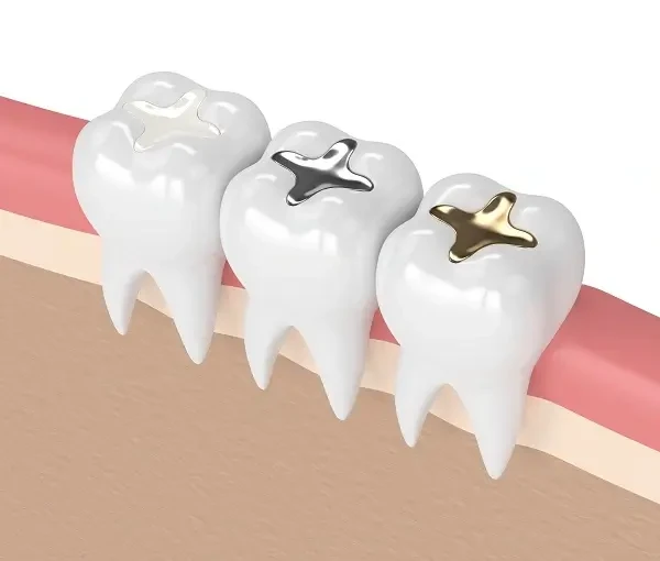 The Beauty of Tooth-Colored Fillings A Modern Approach to Dental Restoration