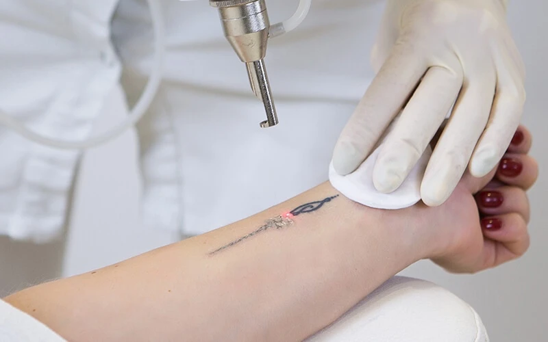 Will Laser Tattoo Removal Damage My Skin?