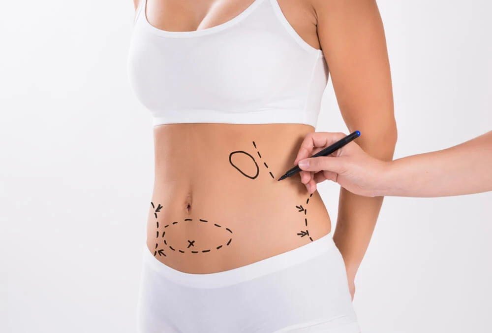 Unveiling Beauty: Liposuction's Role in Enhancing Body Contours in Dubai