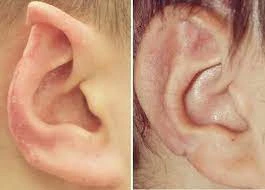 Cosmetic Ear Surgery Pin Back Your Ears