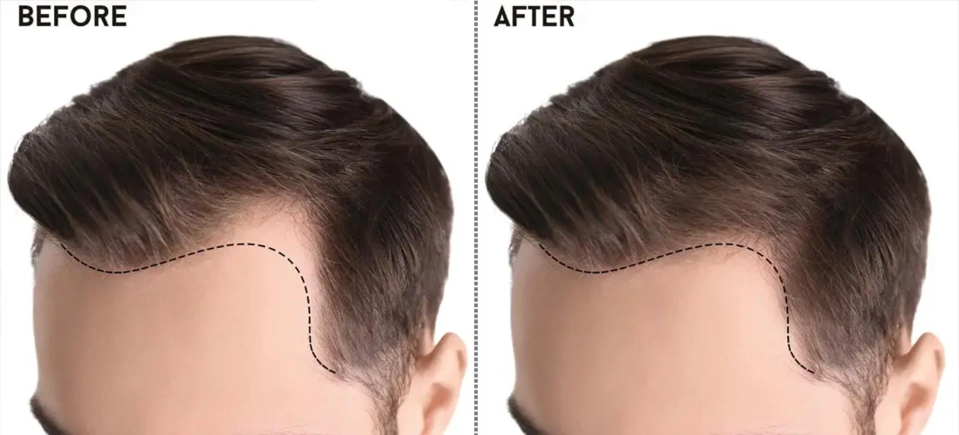 Discovering the Best Hair Transplant Clinics in Islamabad