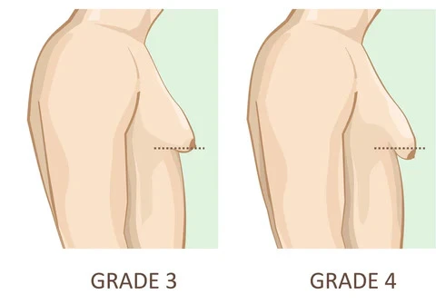 Understanding the Gynecomastia Pinch Test: A Comprehensive Guide