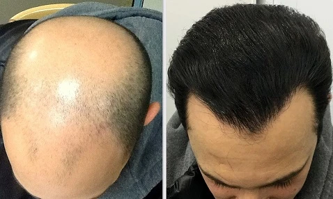 Unveiling the Best Hair Transplant Surgeon in Bangalore: A Gateway to Confidence and Renewed Self-Esteem