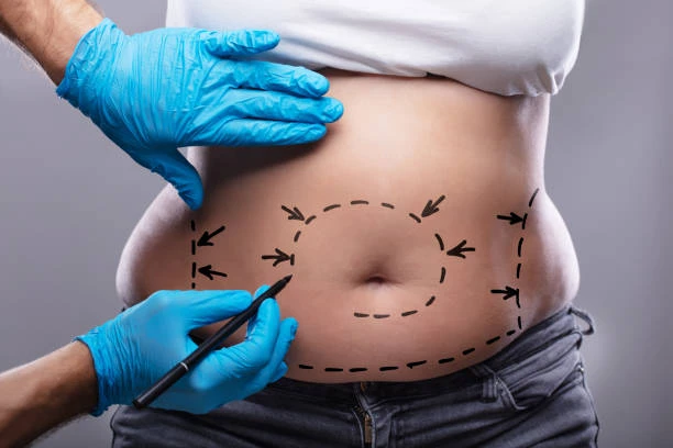 The True Cost of Body Liposuction in Riyadh: What You Need to Know