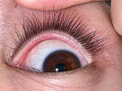 Top Tips for Choosing the Best Eyelid Surgery Doctor in Riyadh