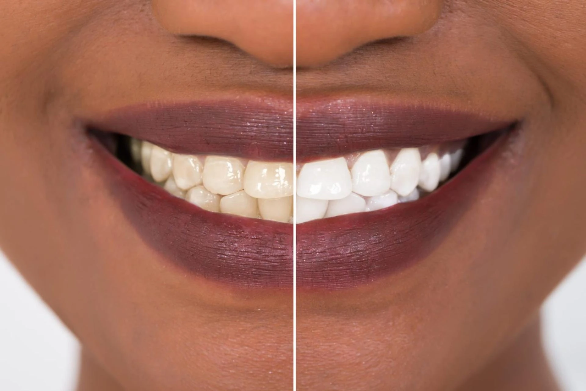 Enhance Your Smile: Teeth Whitening Services in Riyadh