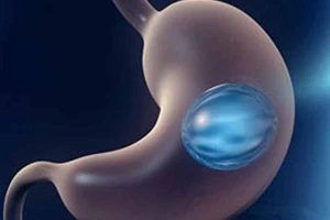 Expert Opinions on Gastric Balloon in Riyadh: What Doctors Say