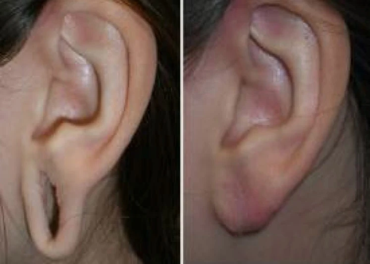 Elevate Your Look: Earlobe Plastic Surgeons in Riyadh