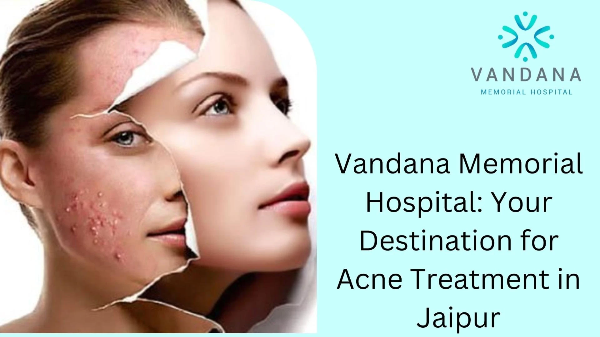 Vandana Memorial Hospital: Your Destination for Acne Treatment in Jaipur
