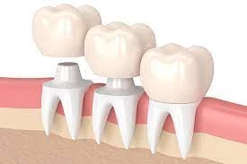 Emergency Care for a Loose Crown