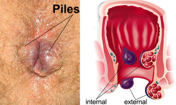 Why CCube Homeopathy is the Best Piles Doctor in Delhi