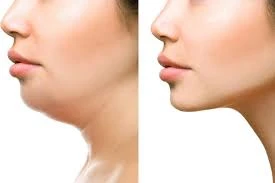 Facial Fat Transfer A Comprehensive Guide