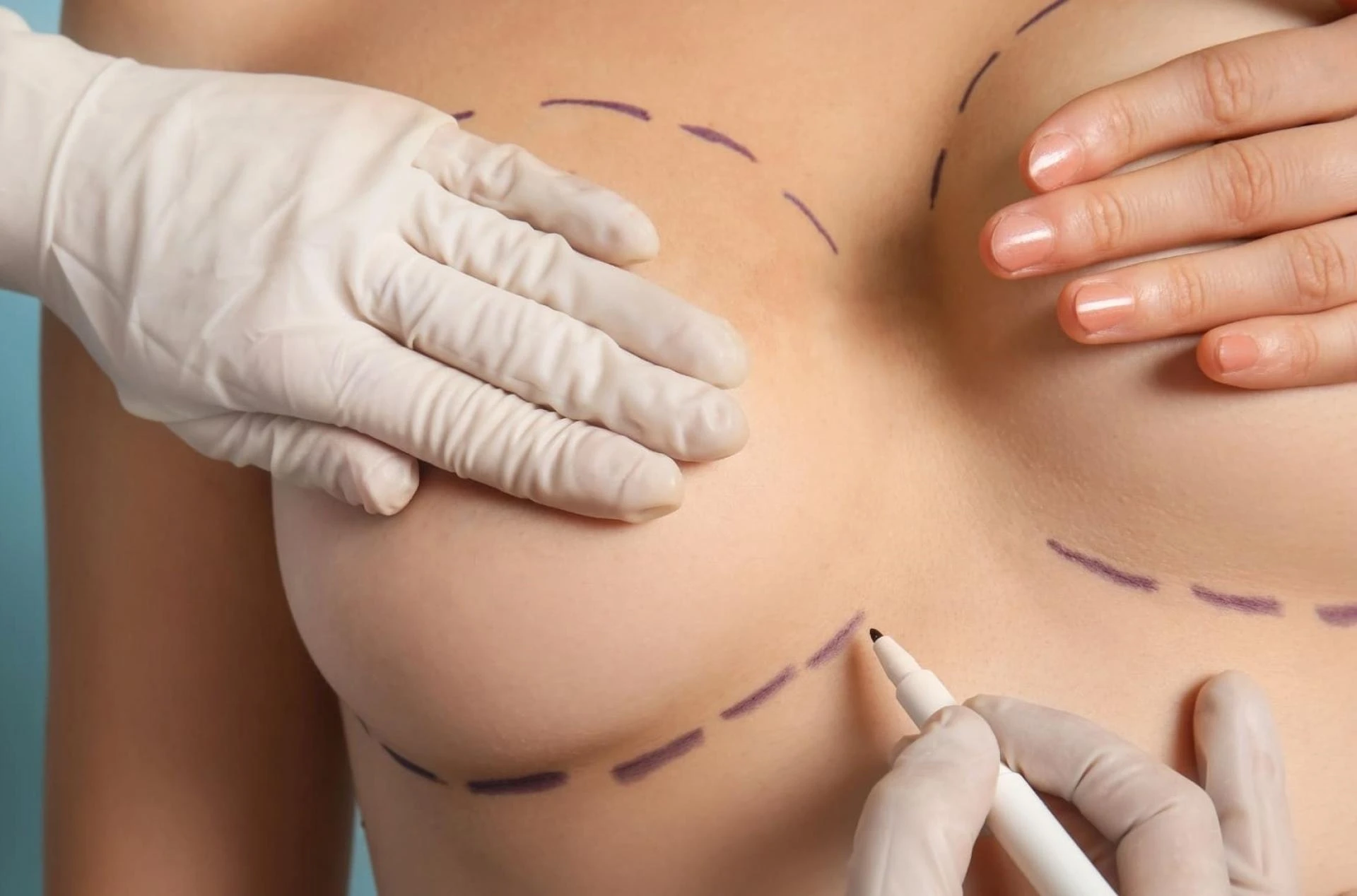 Fat Transfer in Dubai A Step-by Step Guide to the Procedure