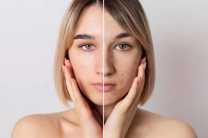 The Impact of Acne Scar Treatments on Self-Esteem and Confidence