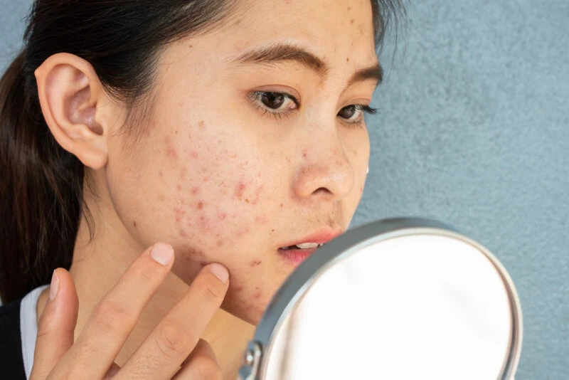 Best Practices for Post-Treatment Care After Acne Scar Removal in Chennai