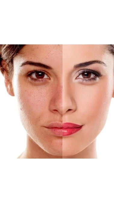 Hyper pigmentation treatment