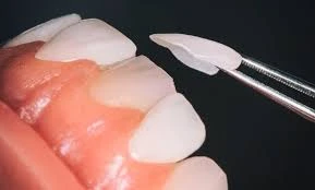 E-Max Veneers Price in Riyadh