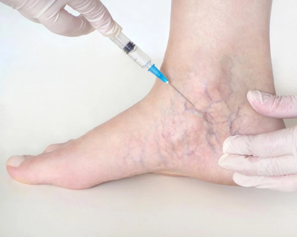 Varicose Veins: What are the Best Treatment Options?