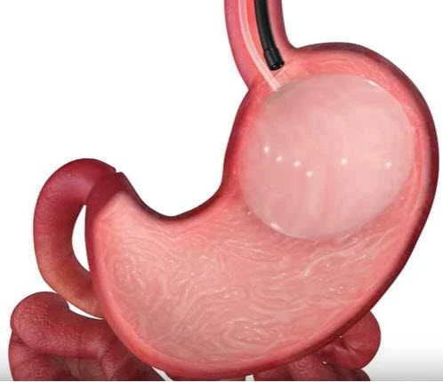 Achieve Your Ideal Weight with Gastric Balloon Surgery