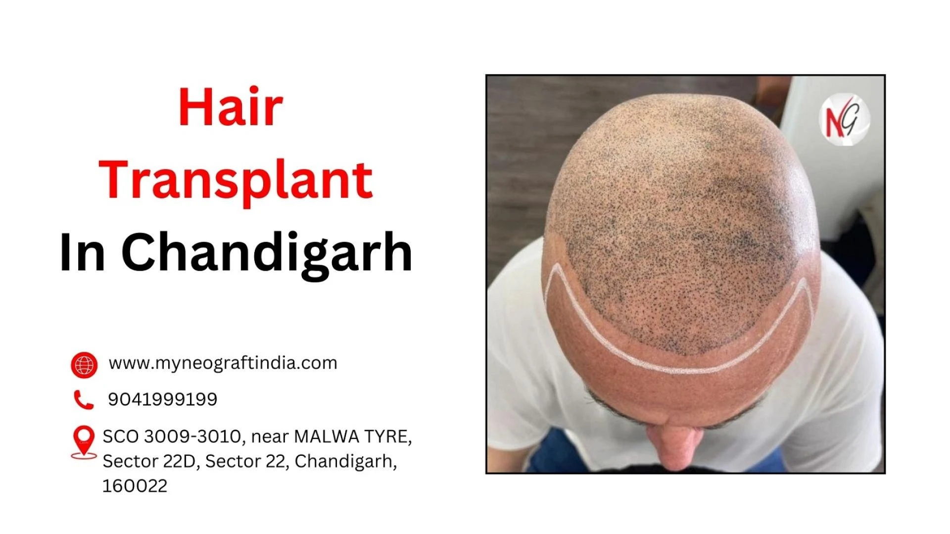 Best Hair Transplant in Chandigarh - NeoGraft India